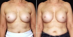 breast-implant-exchange-23788a-gbc