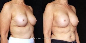 breast-implant-exchange-23788b-gbc
