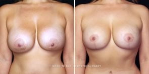 breast-implant-exchange-23841a-gbc