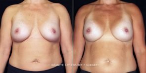 breast-implant-exchange-24377a-gbc