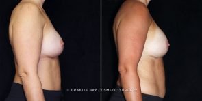 breast-implant-exchange-24377c-gbc