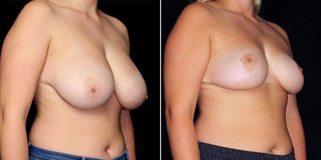 breast-reduction-20278b-gbc