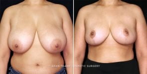 breast-reduction-23388a-gbc