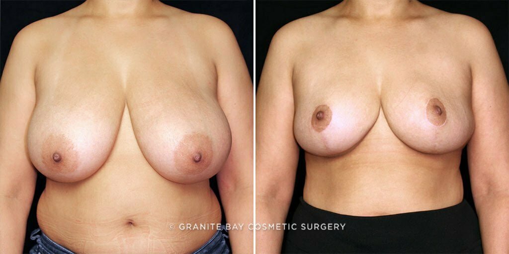 Breast Reduction