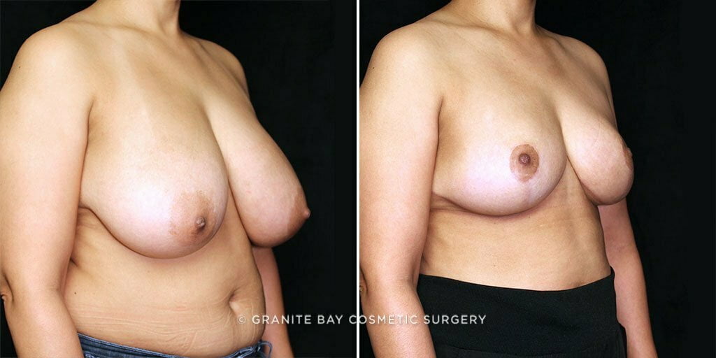 breast-reduction-23388b-gbc
