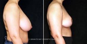 breast-reduction-23388c-gbc