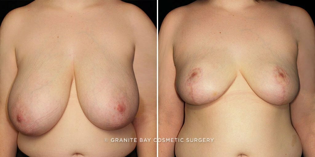 breast-reduction-23925a-gbc