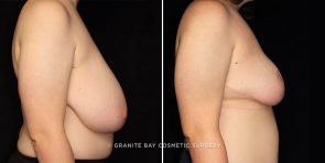 breast-reduction-23925c-gbc