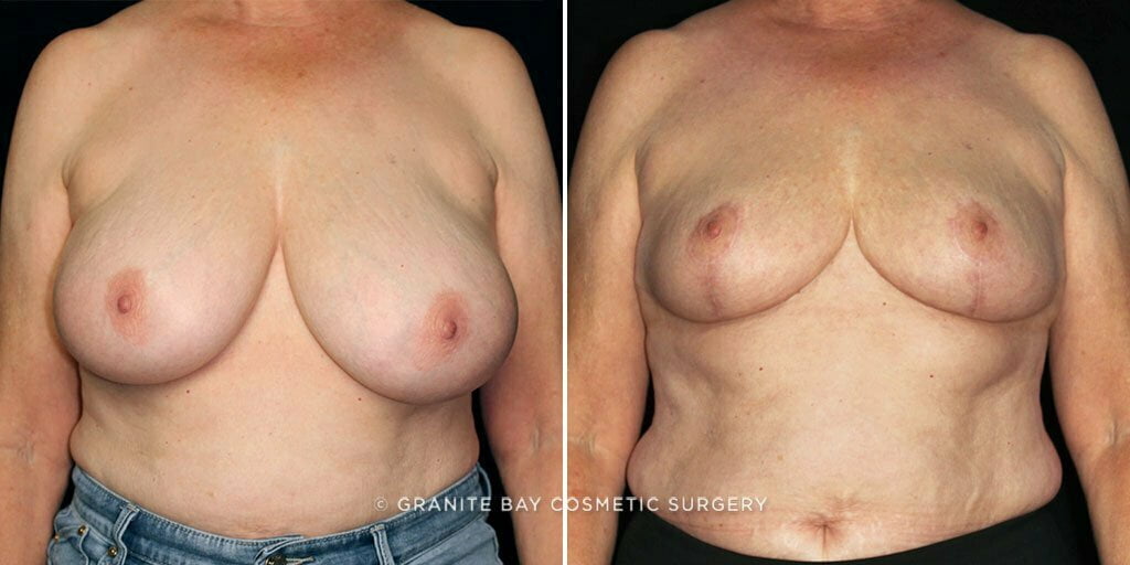 breast-reduction-24464a-gbc