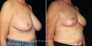 breast-reduction-24464b-gbc