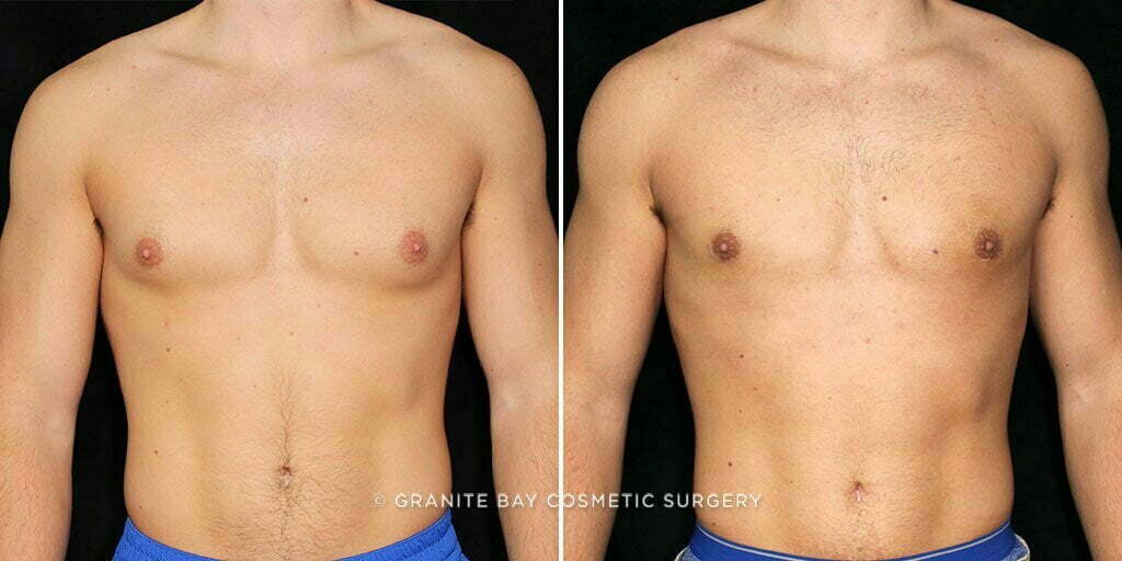 Male Breast Reduction