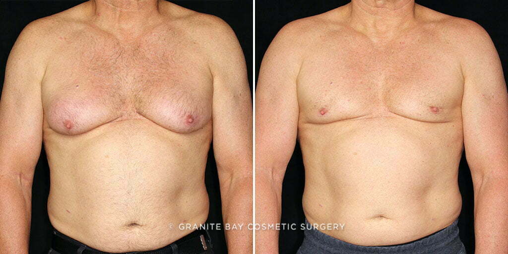 Male Breast Reduction