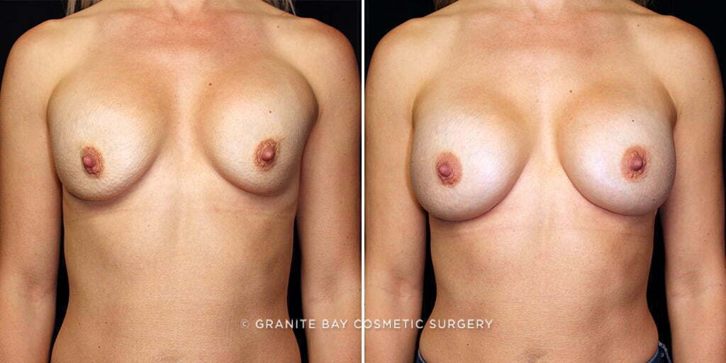 Breast Revision Implant Exchange