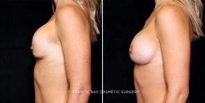 breast-implant-revision-22163c-gbc