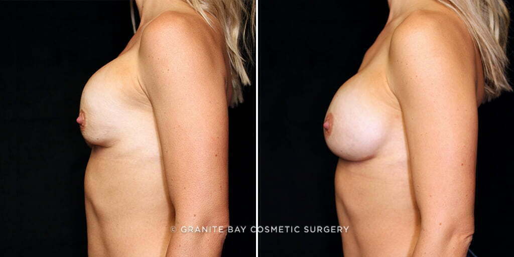 breast-implant-revision-22163c-gbc