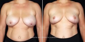 Breast Lift with Implant Removal