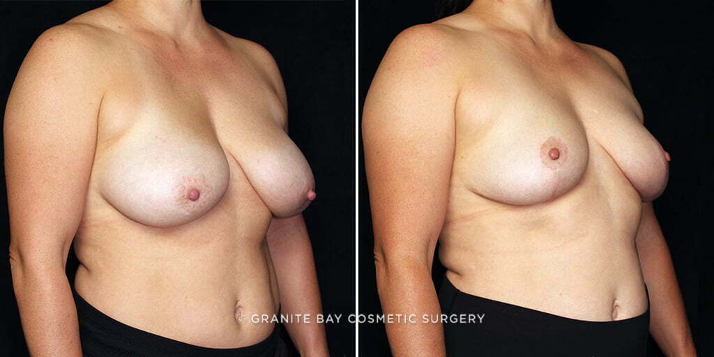 breast-lift-implant-removal-24321b-gbc