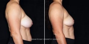 breast-lift-implant-removal-24321c-gbc