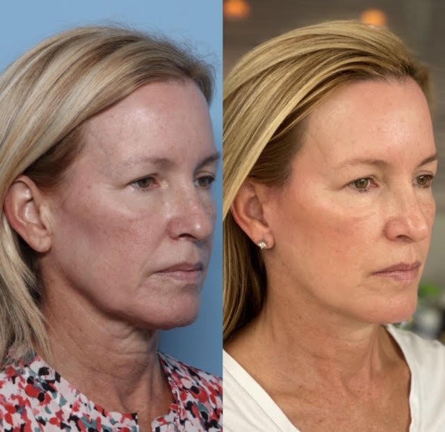 granite bay cosmetic surgery facelift patient before after