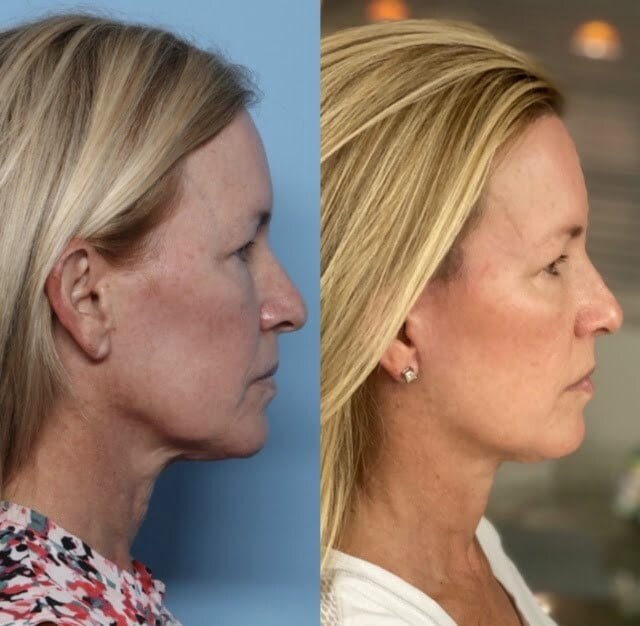 granite bay cosmetic surgery facelift patient before after side view