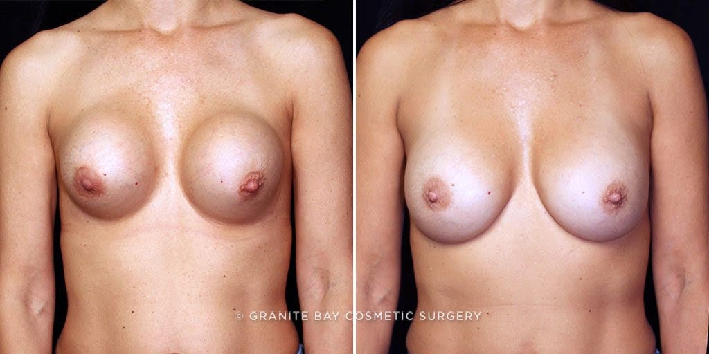 GBCS Capsular Contracture Patient