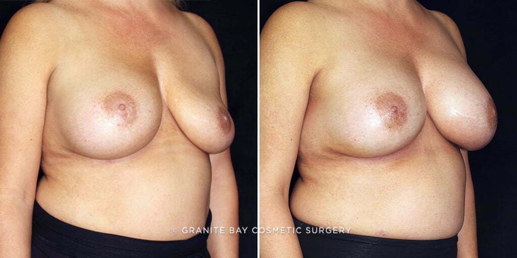 breast-implant-replacement-25812-b-gbc