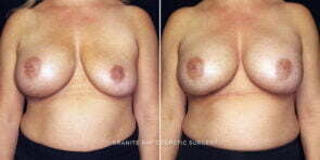 breast-implant-replacement-25812a-gbc