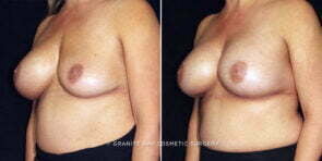 breast-implant-replacement-25812b-gbc