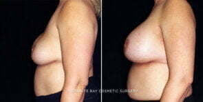 breast-implant-replacement-25812c-gbc