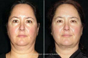 face-cervicomental-liposuction-25584a-gbc