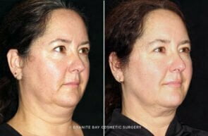 face-cervicomental-liposuction-25584b-gbc