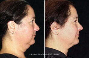 face-cervicomental-liposuction-25584c-gbc