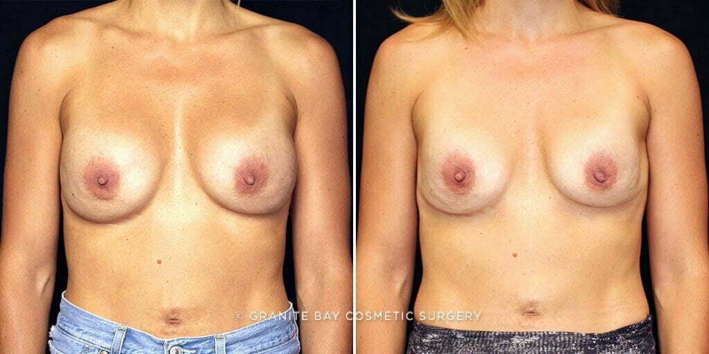 breast-implant-exchange-decrease-7473a-gbc