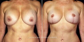 breast-implant-exchange-decrease-liposuction-16640a-gbc
