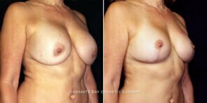 breast-implant-exchange-decrease-liposuction-16640b-gbc