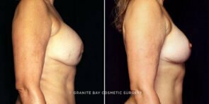 breast-implant-exchange-decrease-liposuction-16640c-gbc