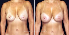 breast-implant-exchange-increase-23971a-gbc