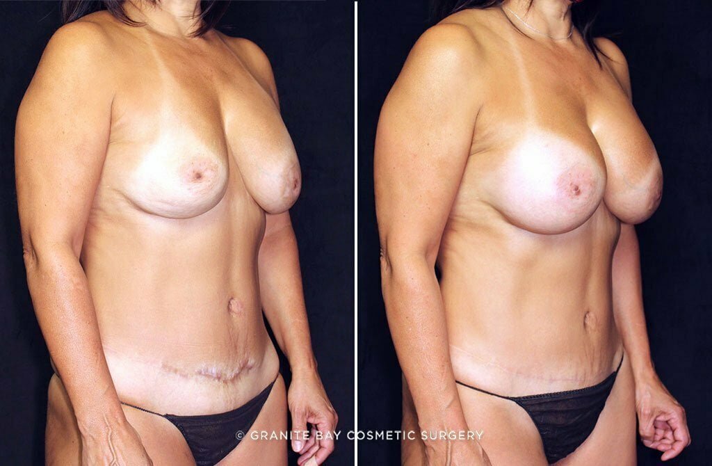 breast-implant-exchange-increase-abdominoplasty-23971b-gbc