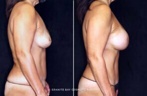 breast-implant-exchange-increase-abdominoplasty-23971c-gbc