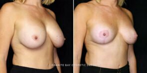 breast-implant-exchange-lift-decrease-17055b-gbc