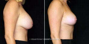 breast-implant-exchange-lift-decrease-17055c-gbc