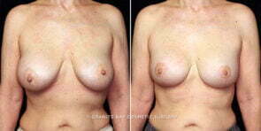 breast-implant-exchange-lift-decrease-23339a-gbc