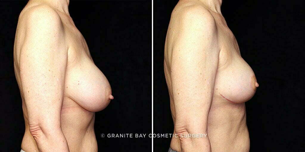 breast-implant-exchange-lift-decrease-23339c-gbc