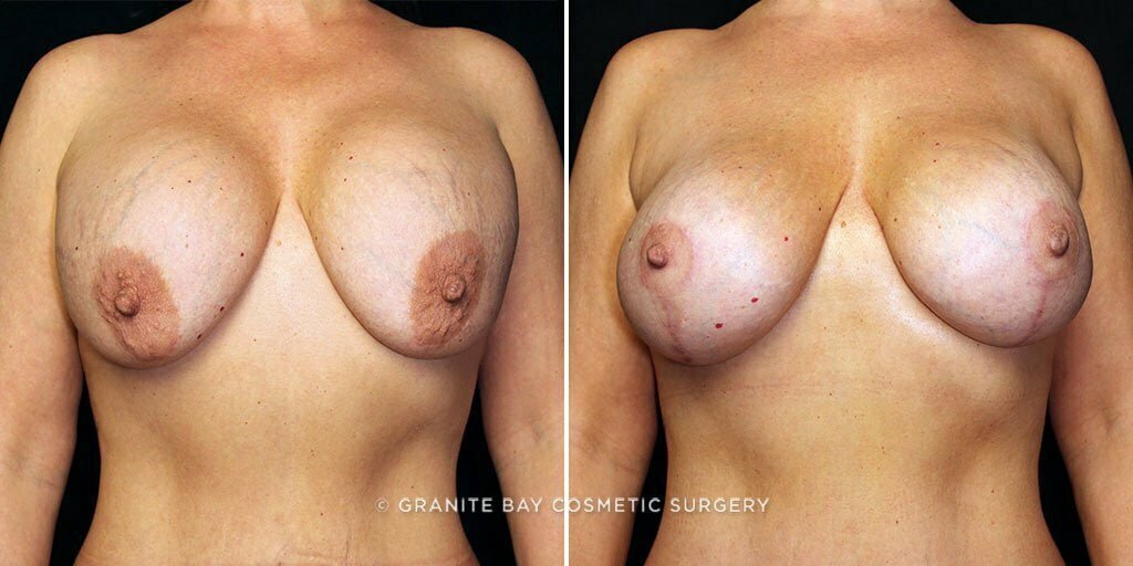 breast-implant-exchange-lift-decrease-24830a-gbc