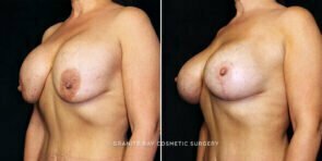 breast-implant-exchange-lift-decrease-24830b-gbc