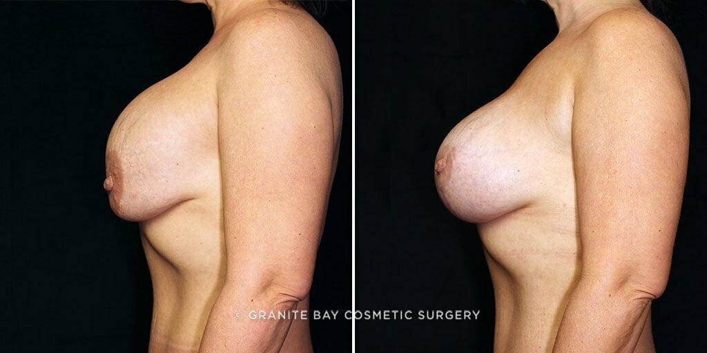 breast-implant-exchange-lift-decrease-24830c-gbc