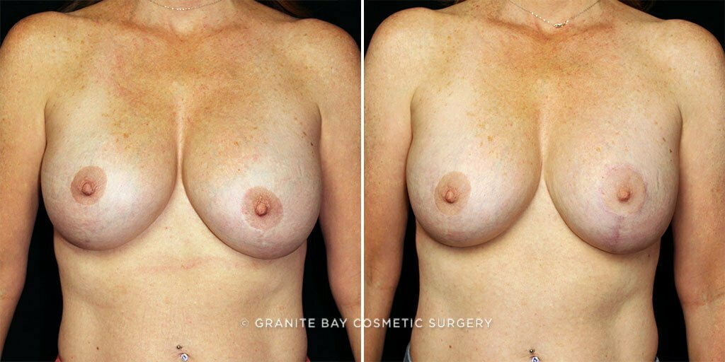Breast lift with implant exchange