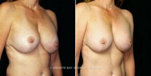 breast-implant-exchange-lift-decrease-25319b-gbc