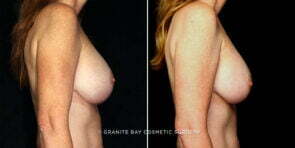 breast-implant-exchange-lift-decrease-25319c-gbc