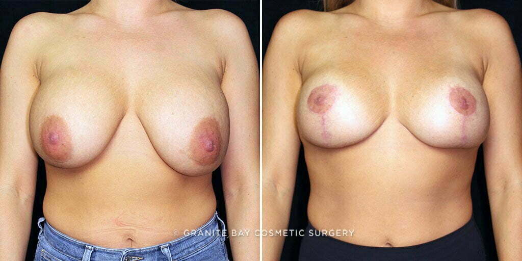 Breast lift with implant exchange